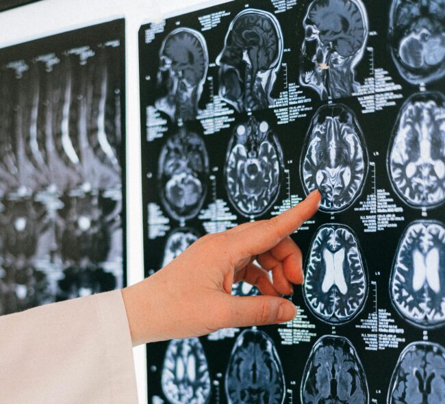 Hands pointing at a brain